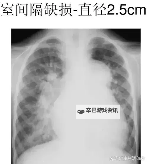 全面整理：免费的胸片大全，助你轻松掌握胸部影像资料图1