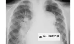 全面整理：免费的胸片大全，助你轻松掌握胸部影像资料